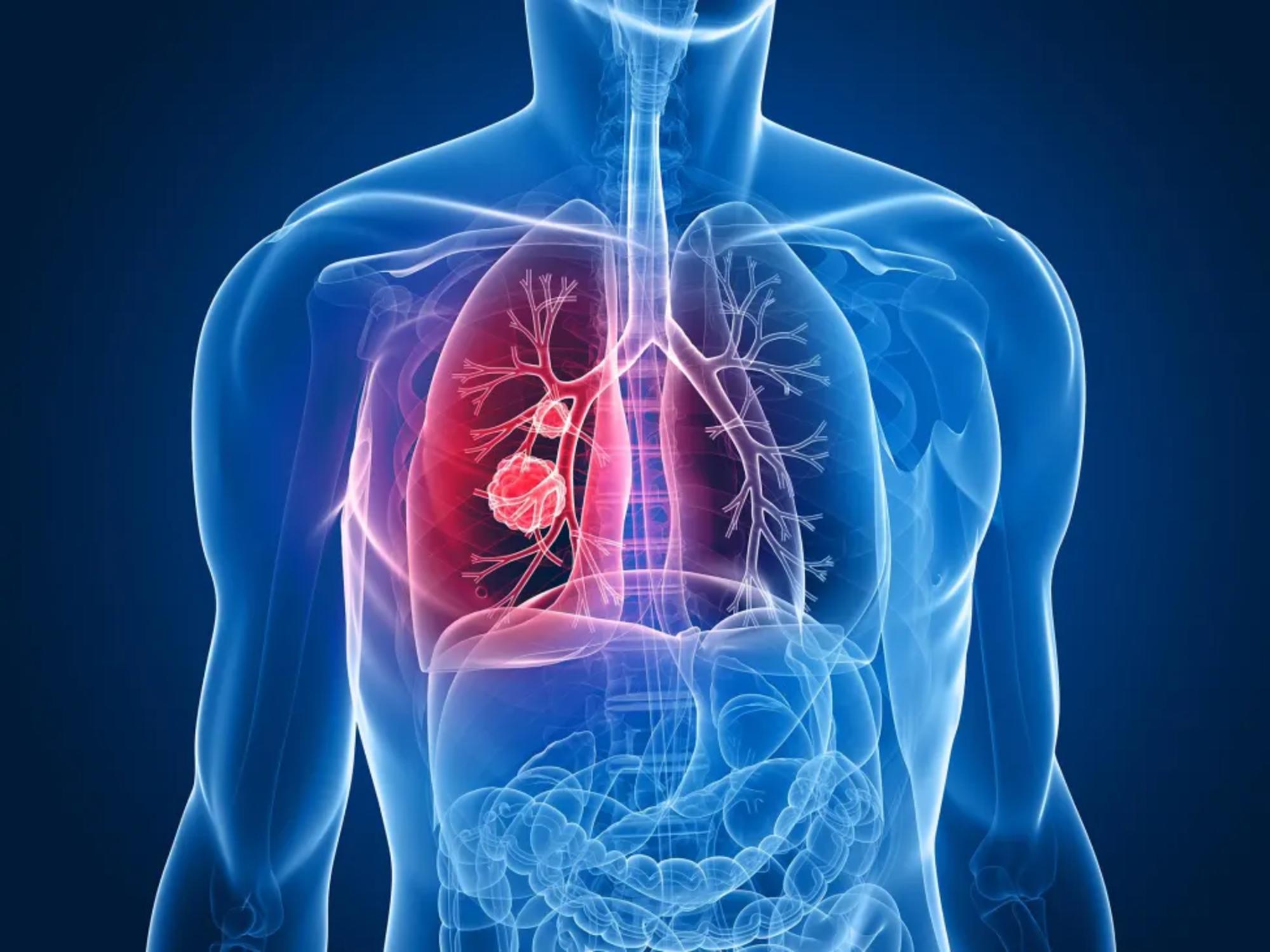 cancer pulmon yale
